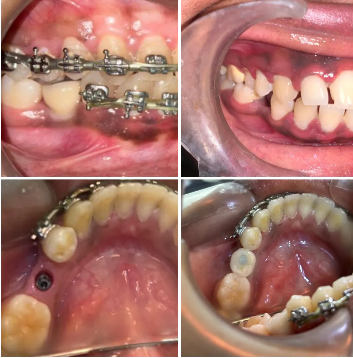 Dental implant restoration