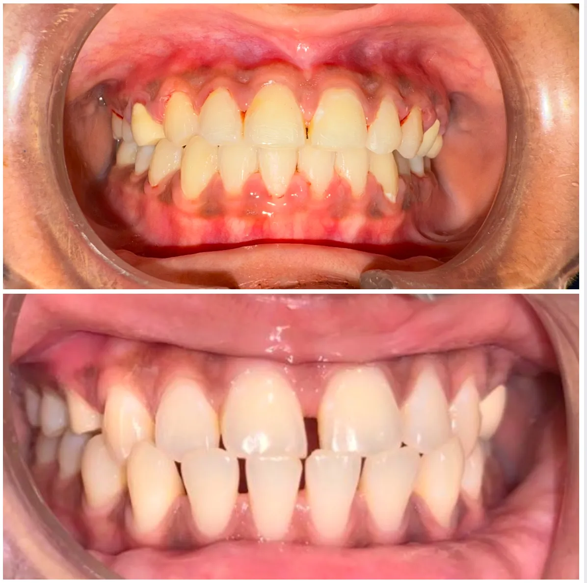 Clear aligners treatment