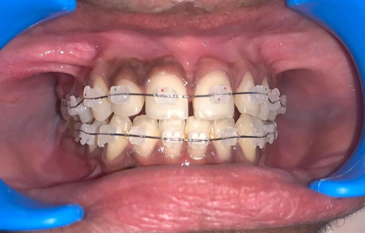 Ceramic braces