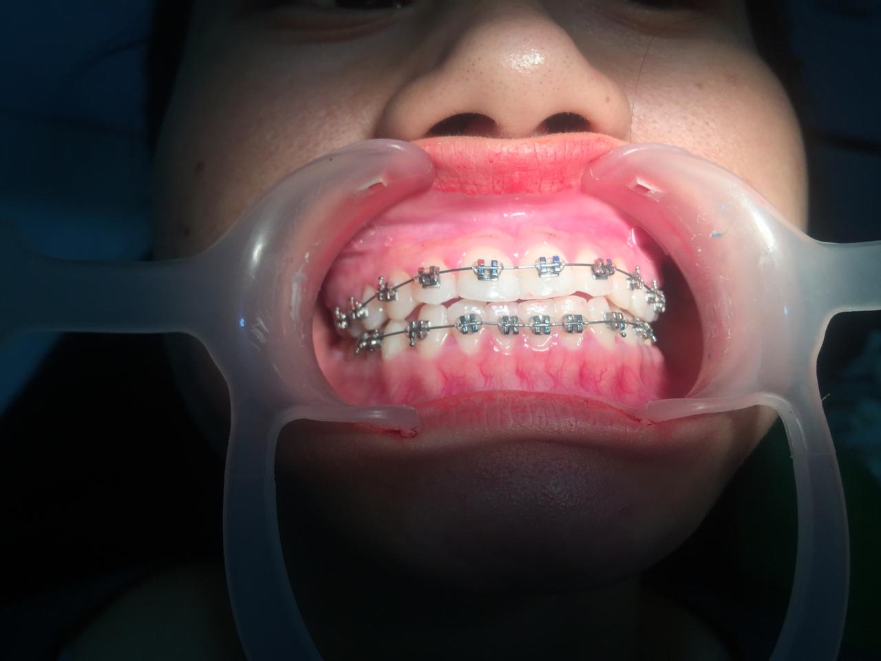 Dental braces alignment